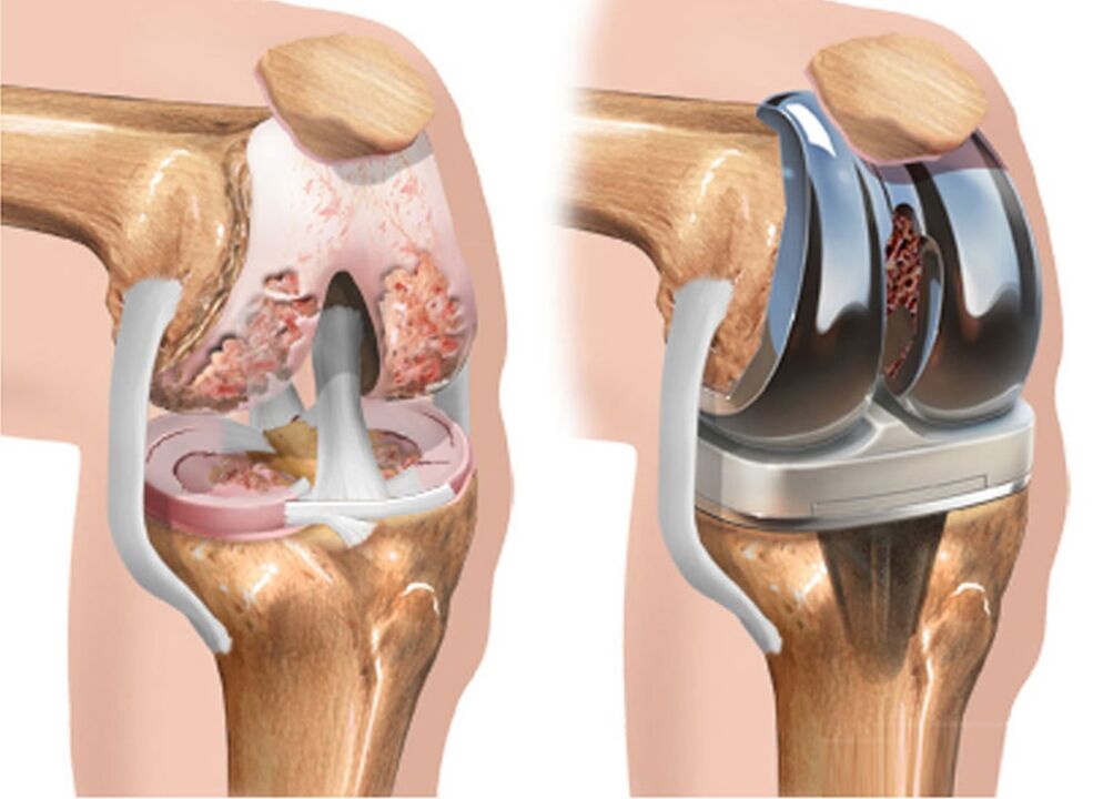 Artroza koljena: liječenje, uzroci, simptomi i tijek