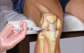 intraartikularna injekcija u zglob zbog artroze
