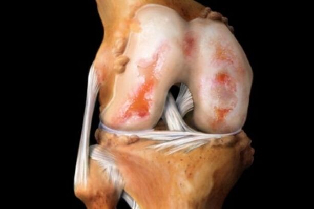 oštećenje hrskavice kod artroze koljena