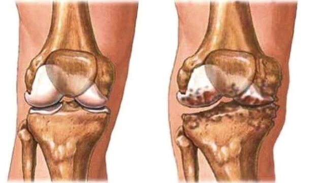 zdravo koljeno i artroza koljena