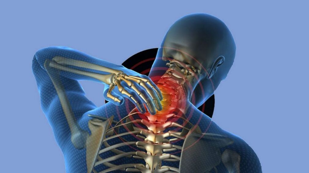 Osteohondroza cervikalne regije