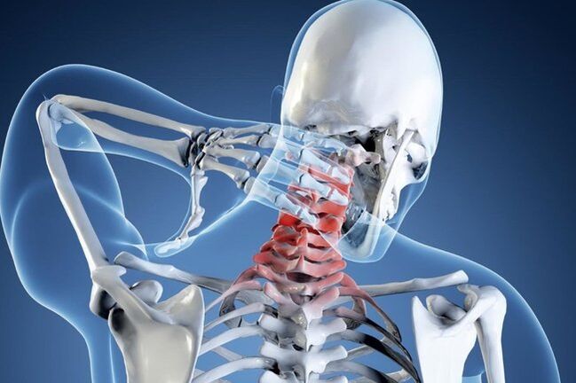 osteohondroza vratne kralježnice